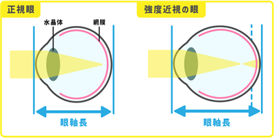 屈折検査